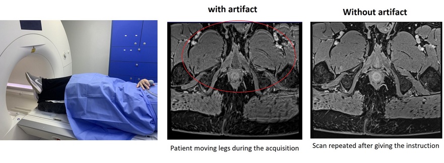 MRI motion artifact due to patient moving legs during the image acquisition