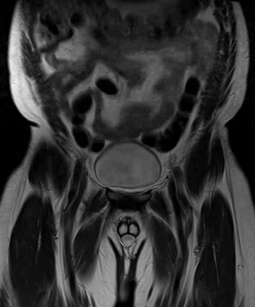 MRI penis T2 tse coronal pelvis 1 - MRI