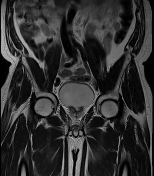 MRI penis T2 tse coronal pelvis 2 - MRI