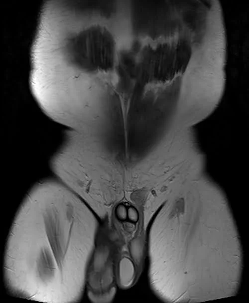 MRI penis T2 tse coronal pelvis - MRI