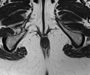 PLAN PROCTO GRAM axial t2 - mrimaster