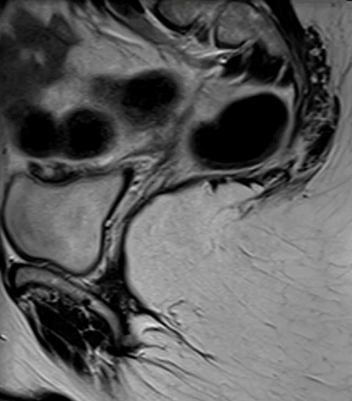 MRI proctogram sagittall T2 high resolution image 1 - MRI