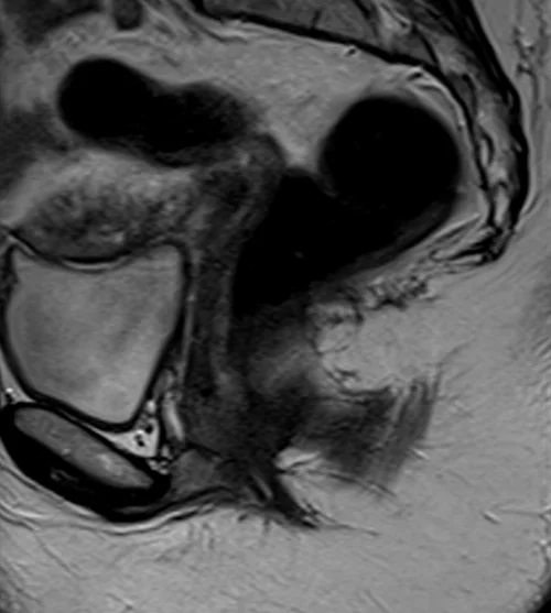 MRI proctogram sagittall T2 high resolution image 2 - MRI