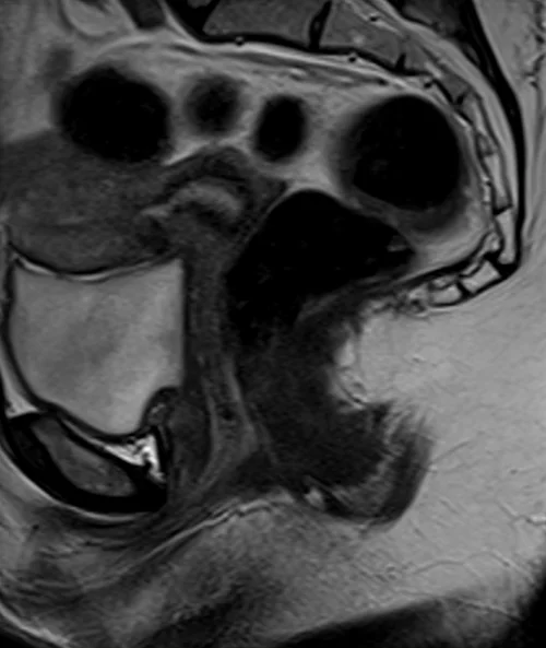 MRI proctogram sagittall T2 high resolution image 3 - MRI
