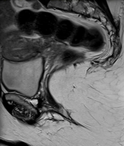 MRI proctogram sagittall T2 high resolution image 4 - MRI