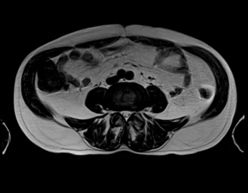MRI rectal cancer big fov axial t2 1 - MRI