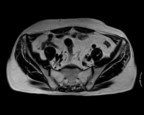 MRI rectal cancer big fov axial t2 2 - MRI