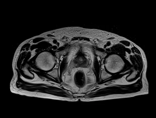 MRI rectal cancer big fov axial t2 3 - MRI