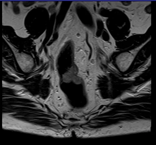 MRI rectal cancer coronal t2 image 2 - MRI
