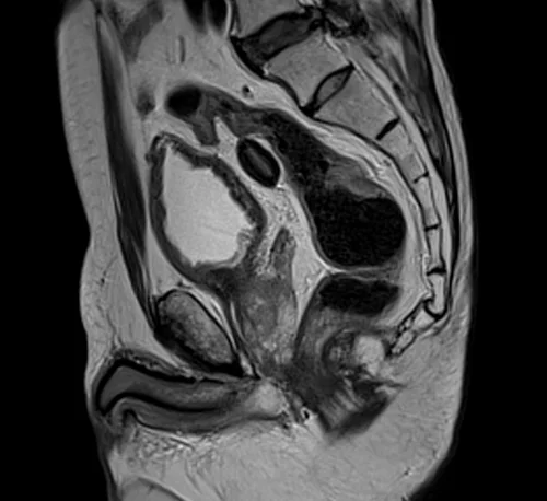 MRI rectal cancer sagittal t2 image 2 - MRI
