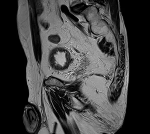 MRI rectal cancer sagittal t2 image 3 - MRI
