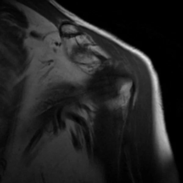 MRI shoulder coronal T1 image 1 - MRI