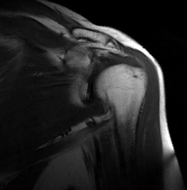 MRI shoulder coronal T1 image 2 - MRI
