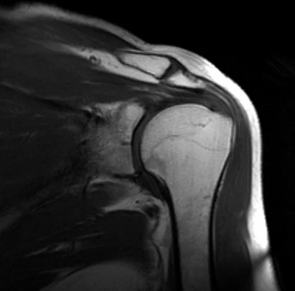 MRI shoulder coronal T1 image 3 - MRI