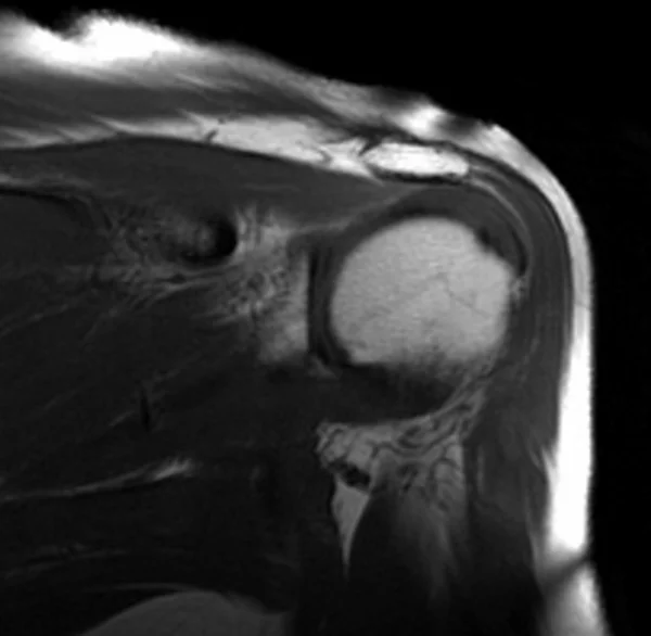 MRI shoulder coronal T1 image 4 - MRI