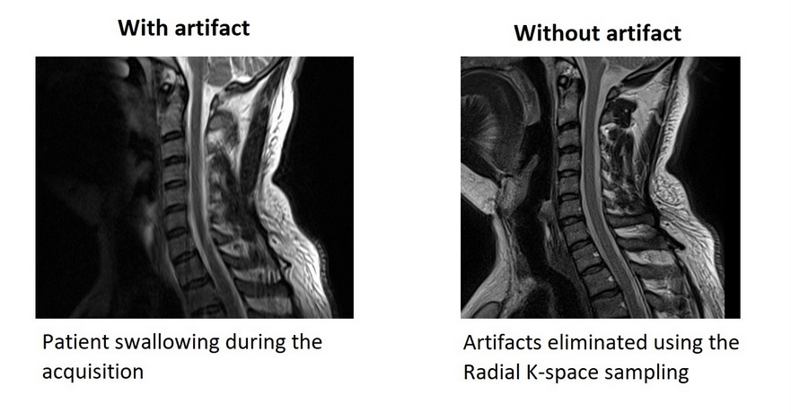 MRI swallowing motion artifact eliminated using radial k-space sampling technique