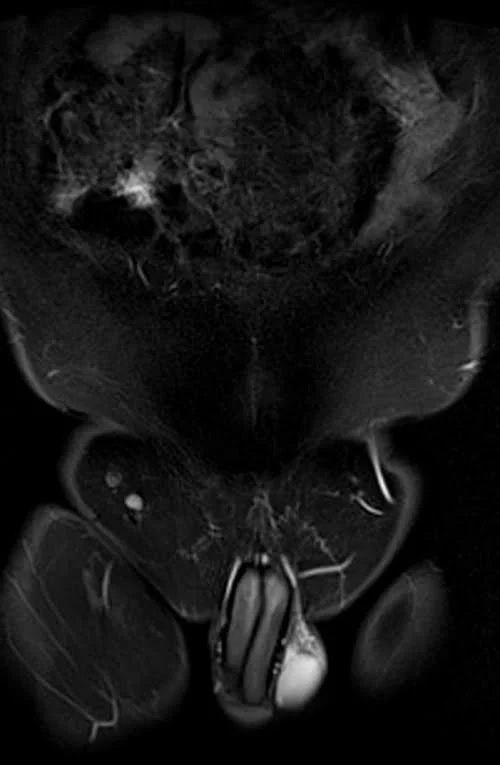 MRI testis big fov coronal stir image 1 - MRI
