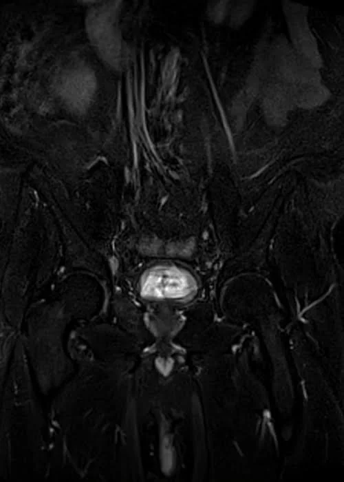 MRI testis big fov coronal stir image 3 - MRI