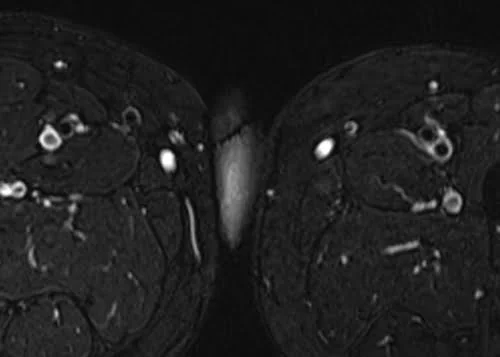 MRI testis sfov axial stir high res image 5 - MRI