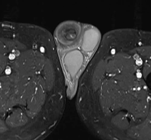 MRI testis sfov axial t1 fat sat high res post contrast image 4 - MRI
