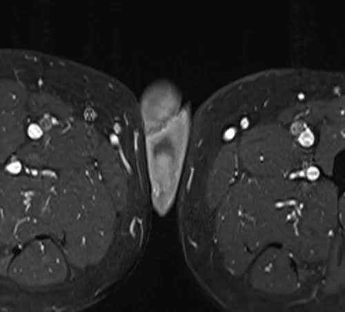 MRI testis sfov axial t1 fat sat high res post contrast image 5 - MRI