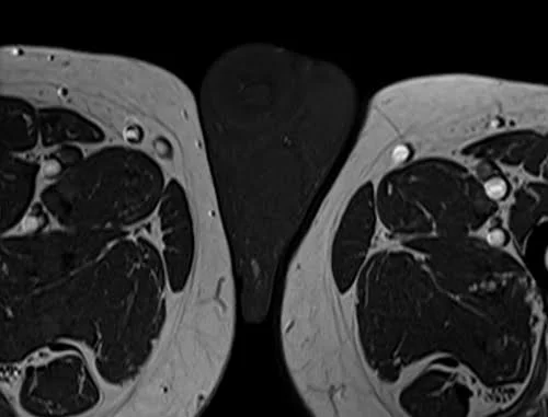 MRI testis sfov axial t1 high res image 4 - MRI