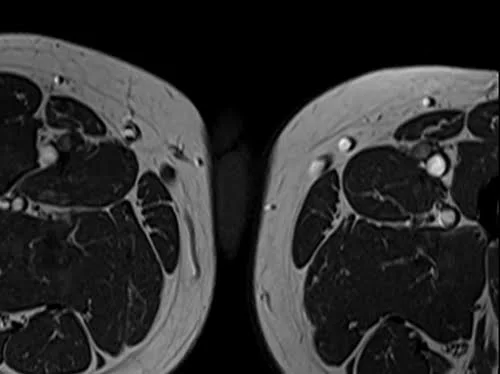 MRI testis sfov axial t1 high res image 5 - MRI