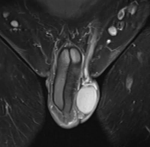 MRI testis sfov coronal t1 fat sat high res post contrast image 1 - MRI