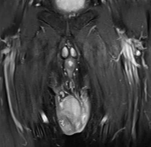 MRI testis sfov coronal t1 fat sat high res post contrast image 2 - MRI