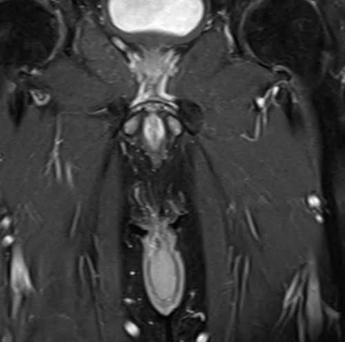 MRI testis sfov coronal t1 fat sat high res post contrast image 3 - MRI