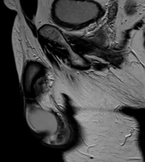 MRI testis sfov sagittal t2 high res image 1 - MRI