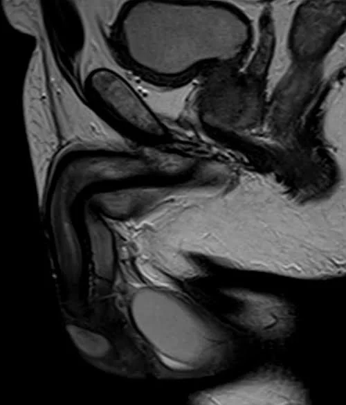 MRI testis sfov sagittal t2 high res image 2 - MRI