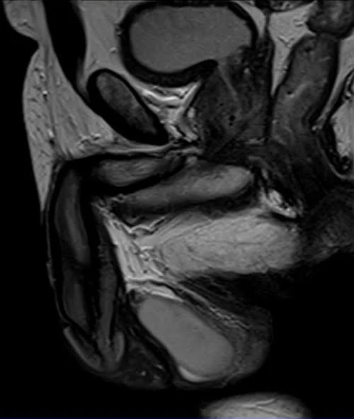 MRI testis sfov sagittal t2 high res image 3 - MRI