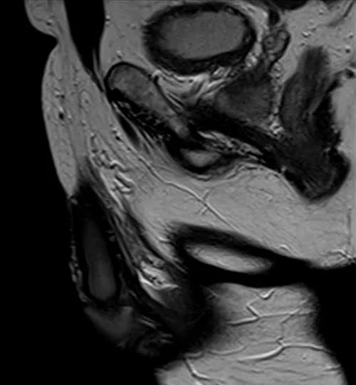 MRI testis sfov sagittal t2 high res image 4 - MRI