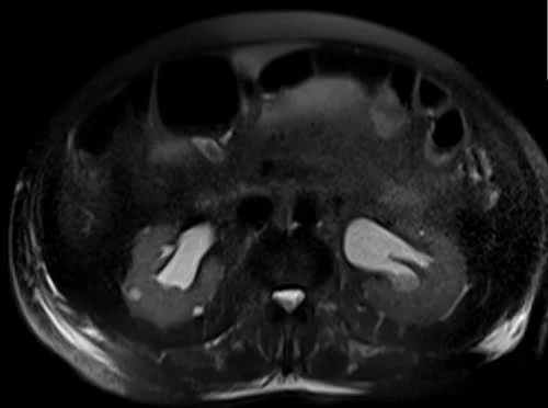 MRI urography axial haste 3mm image 1 - MRI