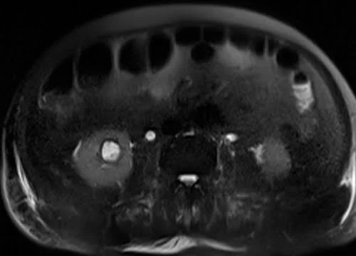 MRI urography axial haste 3mm image 2 - MRI