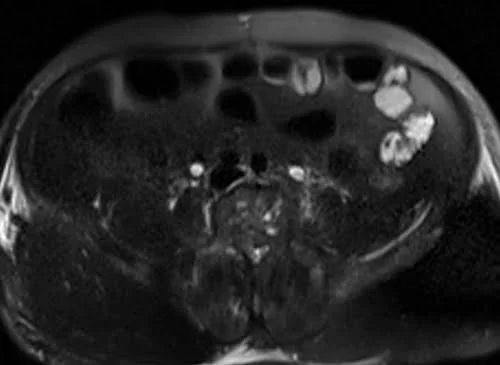 MRI urography axial haste 3mm image 3 - MRI