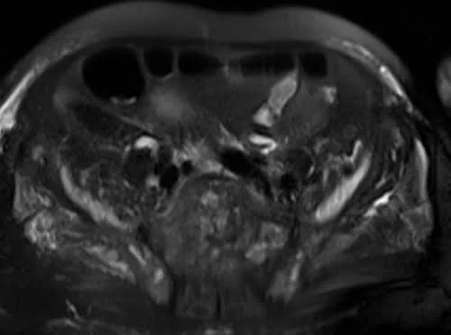 MRI urography axial haste 3mm image 4 - MRI