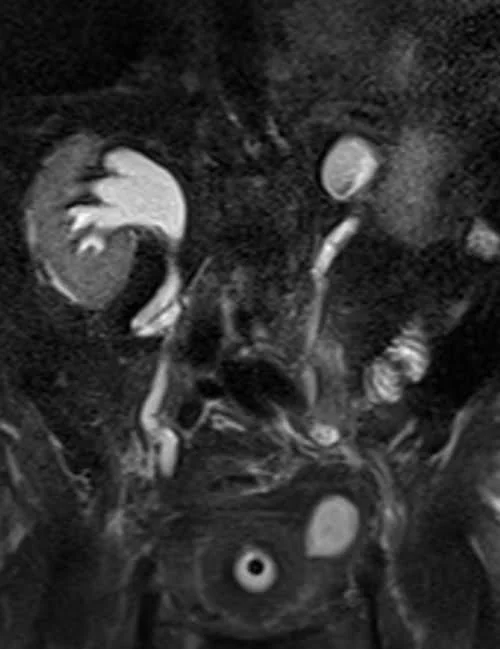 MRI urography coronal haste 3mm image 2 - MRI