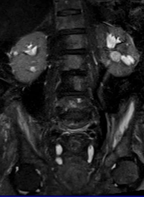 MRI urography coronal haste 3mm image 5 - MRI