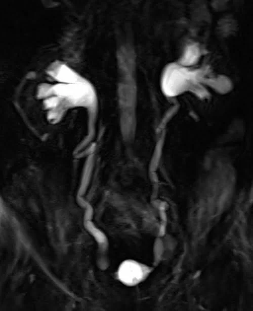 MRI urography coronal haste thick slab image - MRI
