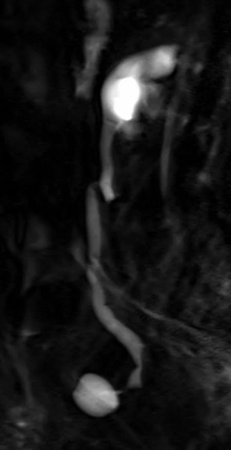 MRI urography sagittal haste thick slab 1 - MRI