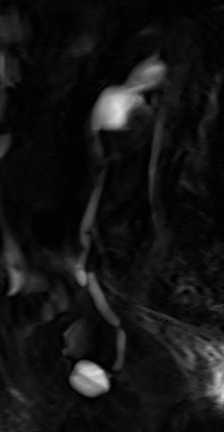 MRI urography sagittal haste thick slab 2 - MRI