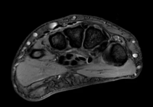 MRI wrist axial medic image 1 - MRI