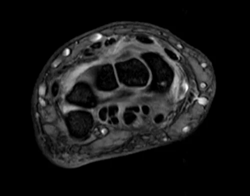 MRI wrist axial medic image 2 - MRI