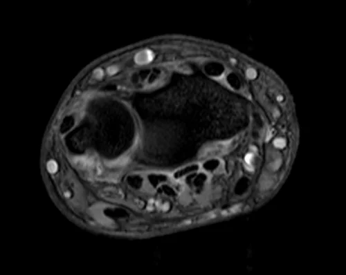 MRI wrist axial medic image 3 - MRI