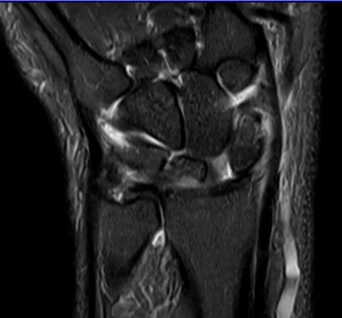 MRI wrist coronal stir image 1 - MRI