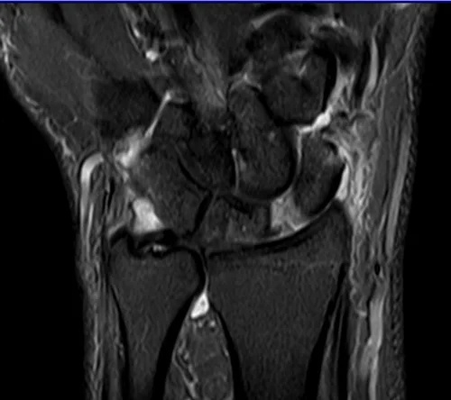 MRI wrist coronal stir image 2 - MRI