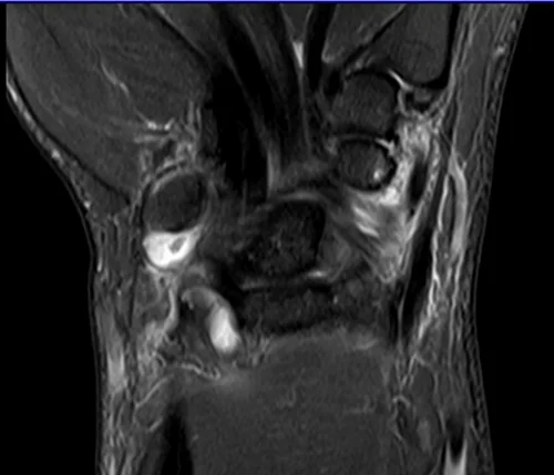 MRI wrist coronal stir image 3 - MRI