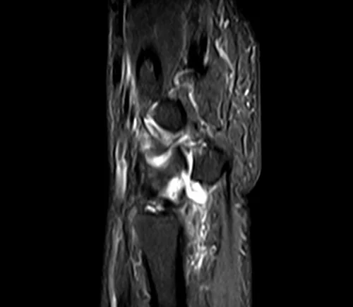 MRI wrist sagittal stir image 1 - MRI